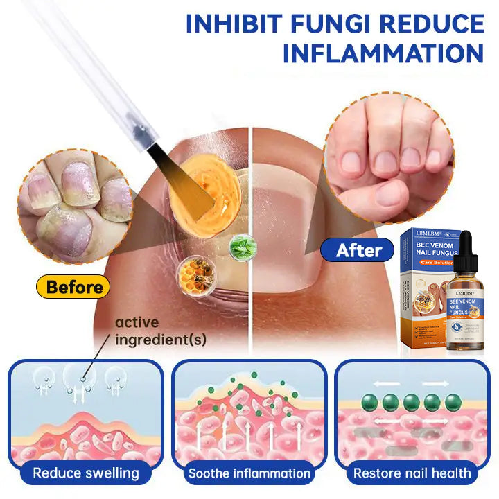 🐝🐝 LBMLBM™  Bee Venom Nail Fungus Treatment Solution: A Complete Solution to Nail Fungus🌟👣