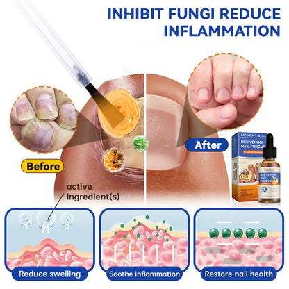🐝🐝 LBMLBM™  Bee Venom Nail Fungus Treatment Solution: A Complete Solution to Nail Fungus🌟👣