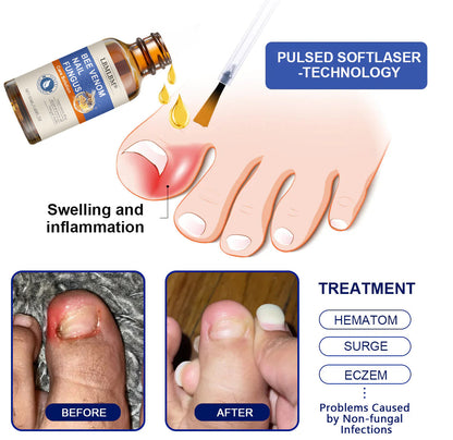🐝🐝 LBMLBM™  Bee Venom Nail Fungus Treatment Solution: A Complete Solution to Nail Fungus🌟👣