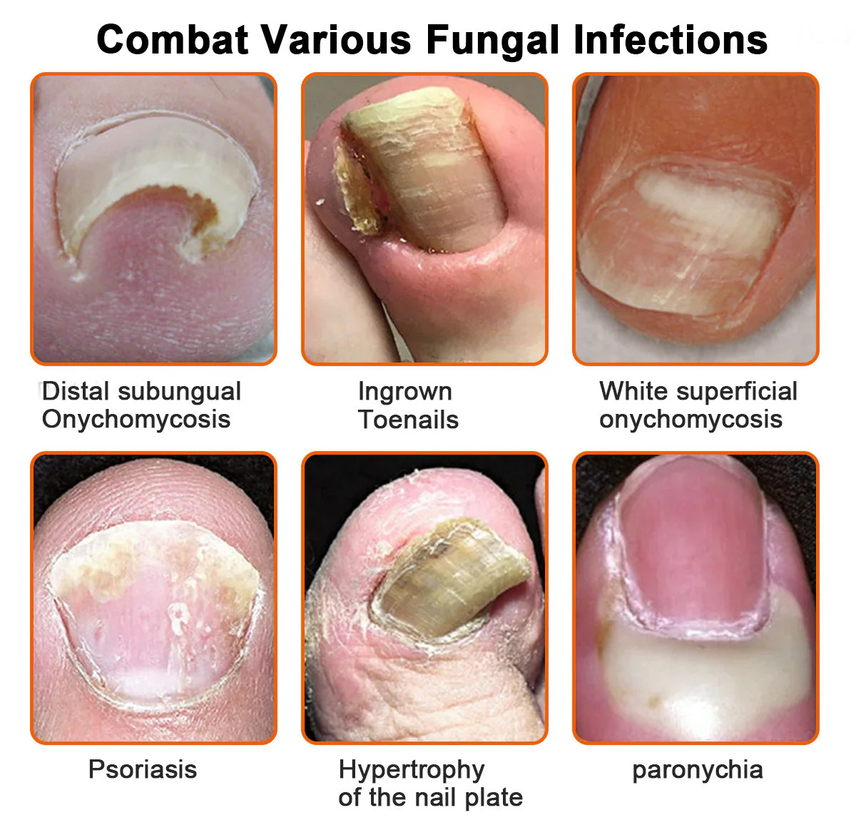 🐝🐝 LBMLBM™  Bee Venom Nail Fungus Treatment Solution: A Complete Solution to Nail Fungus🌟👣
