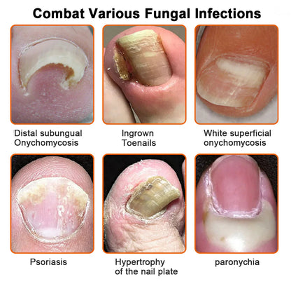 🐝🐝 LBMLBM™  Bee Venom Nail Fungus Treatment Solution: A Complete Solution to Nail Fungus🌟👣